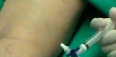 Esclerosis con Espuma