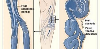 Enfermedad vascular periférica