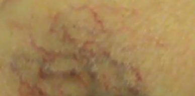 Esclerosis con líquido