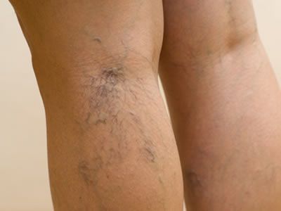 ¿Qué son las varices?