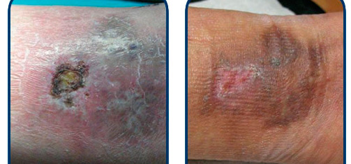 Escleorosis y Ulcera Varicosa