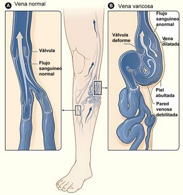 Enfermedad vascular periférica