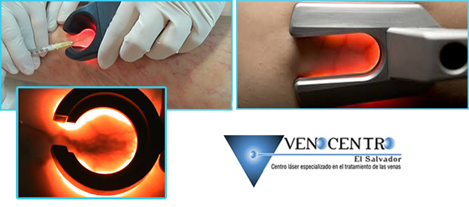 Esclerosis guiada por Transiluminador