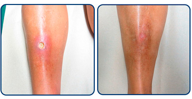 Casos clínicos de ulceras