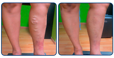 Nuevos casos clínicos de esclerosis